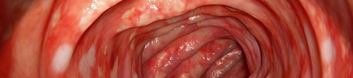 Colitis-ulcerosa1.jpg