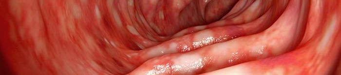 Colitis-ulcerosa2.jpg
